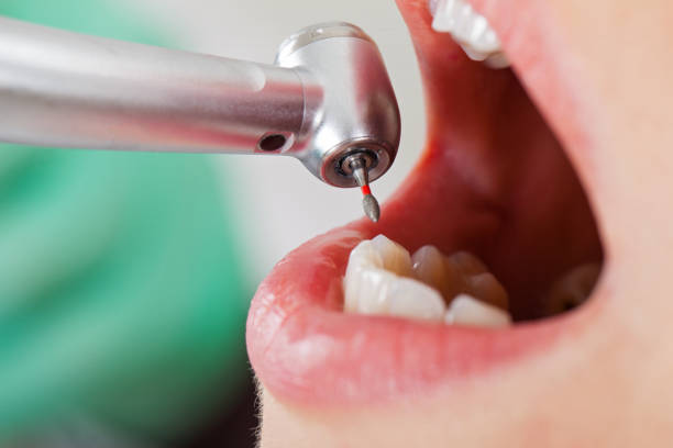 Best Emergency Dentist for Knocked-Out Tooth in Colon, MI